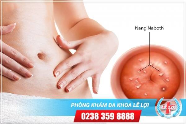 Nang Naboth Cổ Tử Cung Do Đâu Và Phương Pháp Điều Trị Hiệu Quả