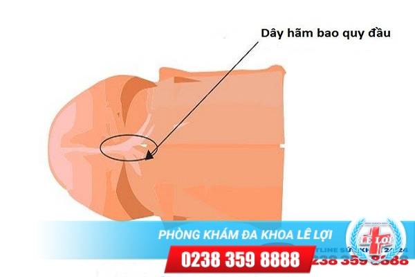 Đứt dây hãm bao quy đầu cần phải làm gì ?