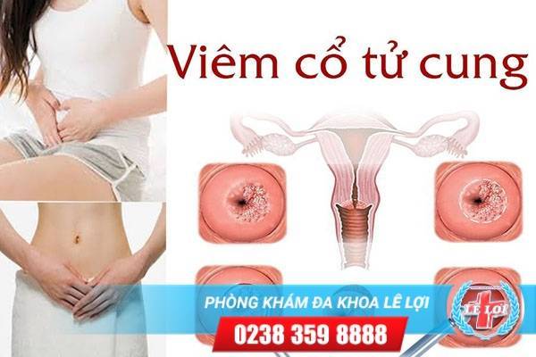 Viêm Cổ Tử Cung Và Cách Hỗ Trợ Chữa Trị Hiệu Quả