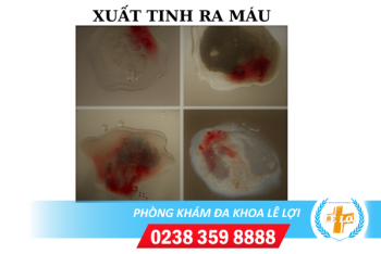 Xuất tinh ra máu có sao không ?