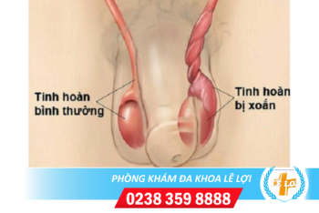 Xoắn tinh hoàn – triệu chứng bệnh nam khoa rất nguy hiểm