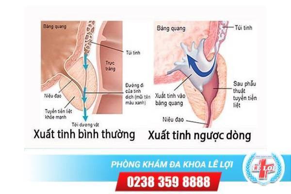 Những dấu hiệu và triệu chứng của xuất tinh ngược