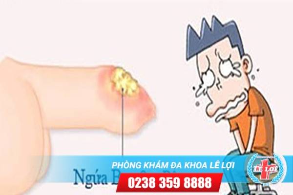 Ngứa bao quy đầu – đừng bao giờ bỏ qua