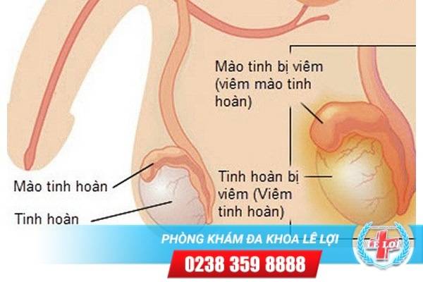 Tìm hiểu về bệnh viêm mào tinh hoàn