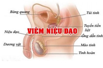 Các cách xét nghiệm chẩn đoán viêm niệu đạo cho nam giới