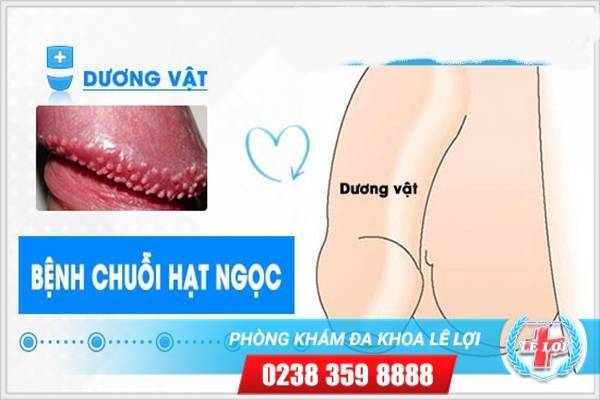 Nguyên nhân dẫn đến dãy hạt ngọc dương vật