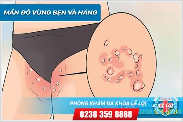 Mẩn đỏ vùng bẹn và háng xử lí như thế nào ?