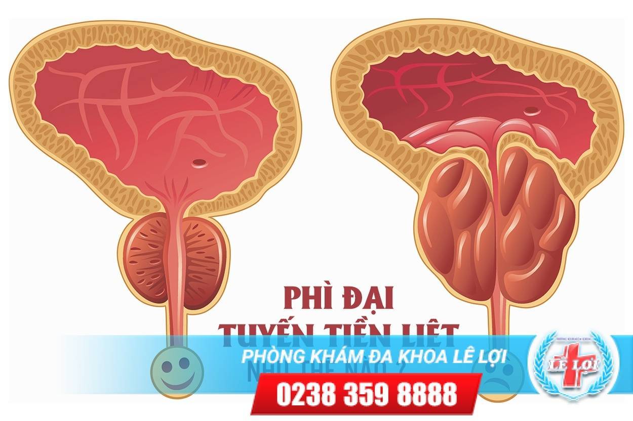 Phì đại tuyến tiền liệt là như thế nào ?