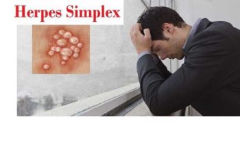 Herpes sinh dục là gì ?