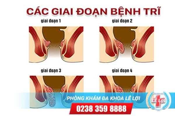 Các giai đoạn bệnh trĩ và cách điều trị