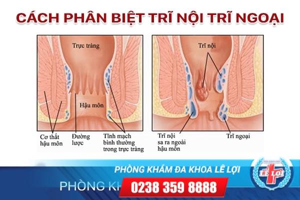 Phân biệt trĩ nội, trĩ ngoại như thế nào?