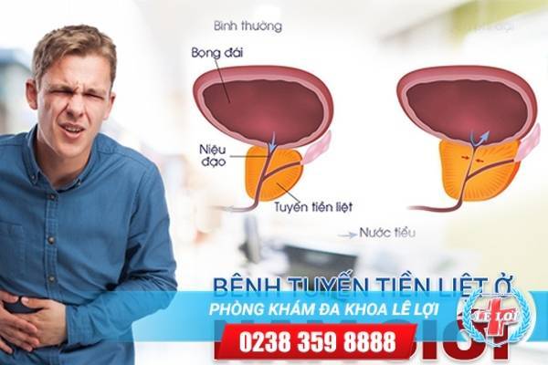 Dấu hiệu nhận biết những bệnh tuyến tiền liệt ở nam giới