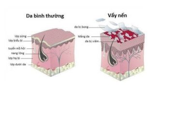 Hiện tượng vẩy nến ở dương vật