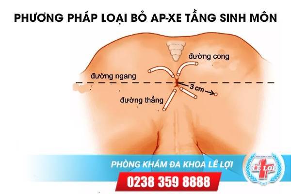 Phương pháp loại bỏ ap-xe tầng sinh môn - Liệu trình một lần duy nhất