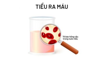 Đi tiểu ra máu là đang mắc bệnh gì?