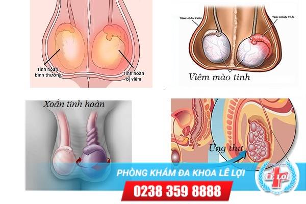 Sưng tinh hoàn là triệu chứng bệnh gì có nguy hiểm không?