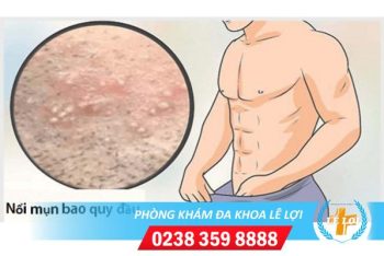 Nổi mụn ở bao quy đầu là bị bệnh gì?