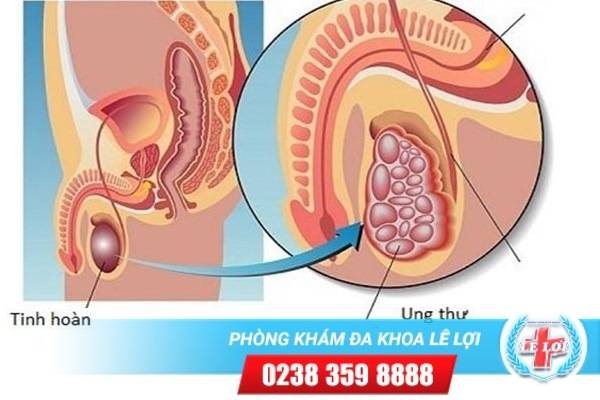 Dấu hiệu nhận biết ung thư tinh hoàn và cách điều trị hiệu quả