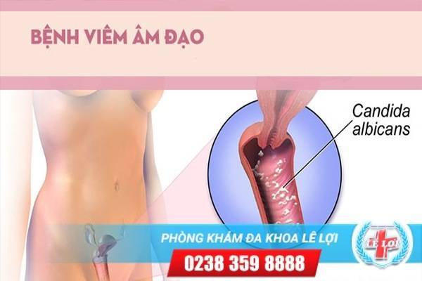 Dấu hiệu nhận biết bị viêm âm đạo