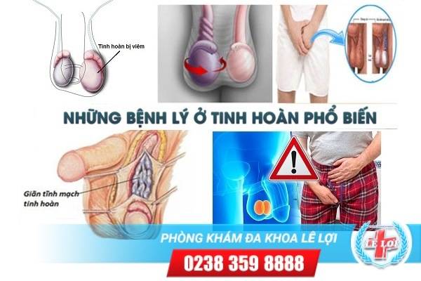 Có khối u tinh hoàn là bị bệnh gì?