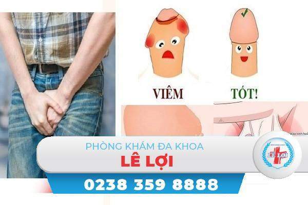 Một số bệnh viêm nam khoa nam giới thường hay gặp và dễ mắc phải