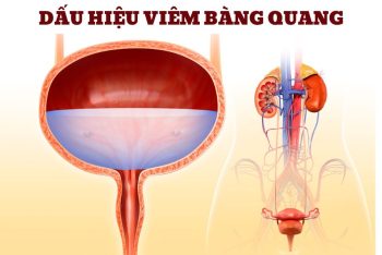 Bệnh viêm bàng quang và những kiến thức cần biết