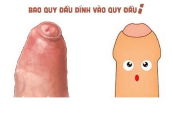 Dính bao quy đầu có nguy hiểm không?