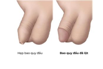 Hẹp bao quy đầu là gì và có nên cắt bao quy đầu bị hẹp không?