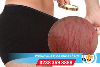 Nứt da quy đầu do đâu? Dấu hiệu và phương pháp hỗ trợ điều trị