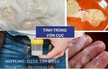 Tinh trùng vón cục ở nam giới là như thế nào ?