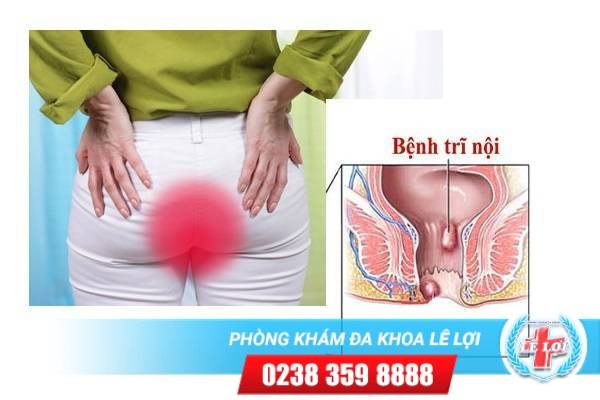 Cách điều trị trĩ nội hiệu quả địa chỉ uy tín