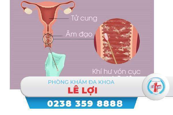 Khí hư vón cục là bị bệnh gì cách điều trị