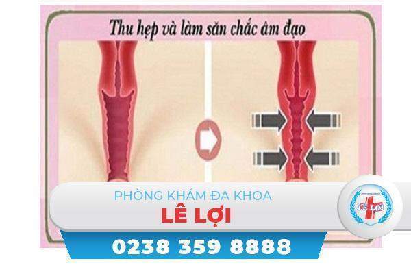 Thu hẹp âm đạo giải pháp giữ lửa hôn nhân bền lâu