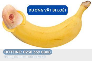 Dương vật bị lở loét nguyên nhân và cách điều trị