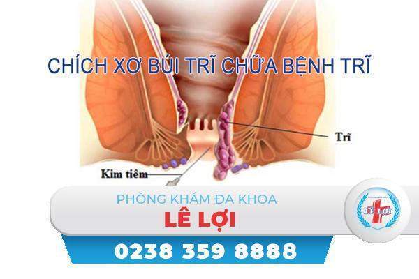 Chích xơ búi trĩ có hiệu quả không?