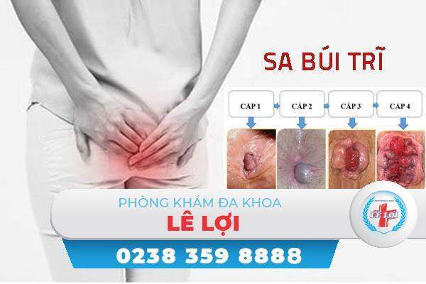 Nguyên nhân sa búi trĩ và cách điều trị