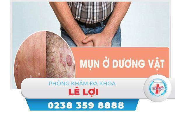 Mọc mụn cậu nhỏ là bị bệnh gì?