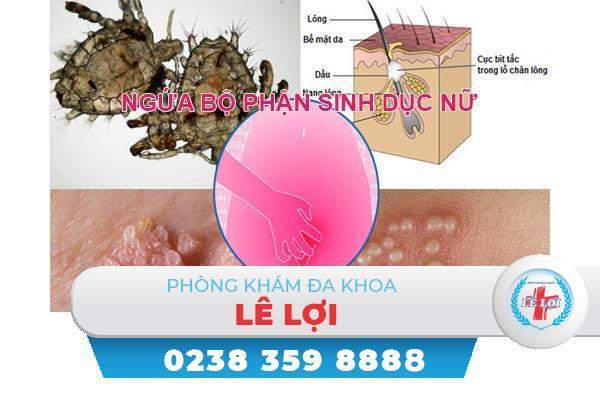 Ngứa bộ phận sinh dục nữ là dấu hiệu của bệnh gì?