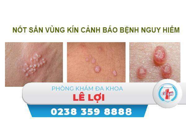 Nốt sần ở vùng kín là bị bệnh gì?