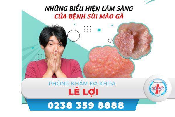 Bệnh sùi mào gà – Một trong các bệnh xã hội nguy hiểm hiện nay