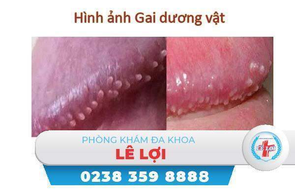 Gai dương vật là bệnh gì nguy hiểm không?