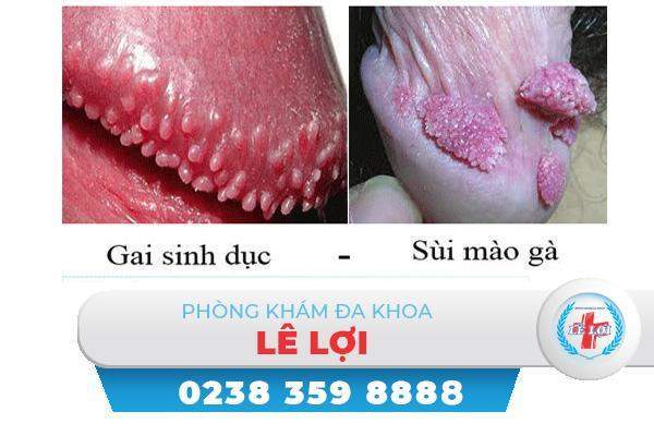 Gai sinh dục là bệnh gì nguy hiểm không?