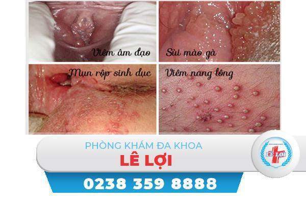 Mọc nhọt ở môi lớn, môi bé là do đâu?