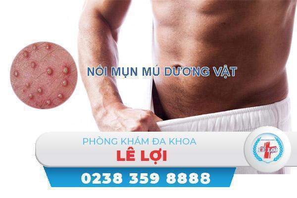 Nổi mụn mủ dương vật là bị bệnh gì?