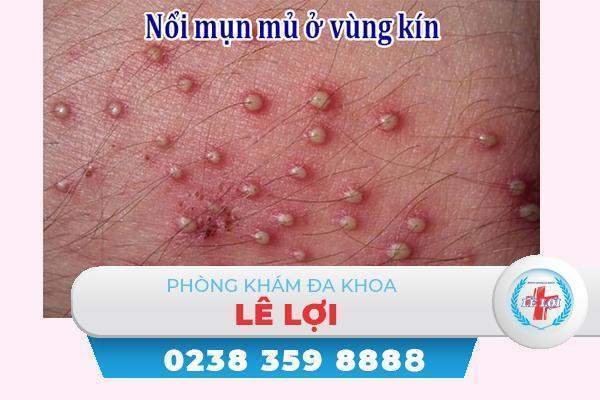 Nguy hiểm khôn lường khi nổi mụn mủ vùng kín