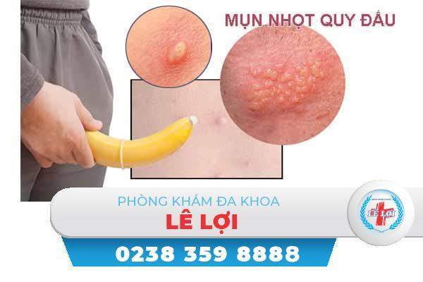 Điểm danh những nguyên nhân gây nổi mụn nhọt quy đầu