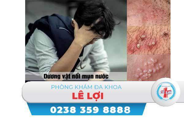 Nổi mụn nước dương vật và cách điều trị