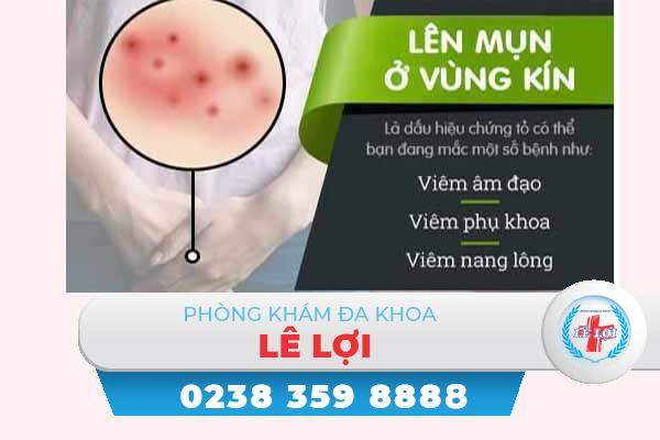 Mụn nước ở môi bé + môi lớn là bị bệnh gì?