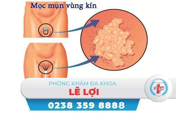 Nổi mụn sinh dục – điều trị sớm để tránh biến chứng