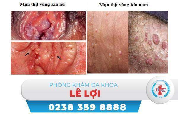 Mụn thịt vùng kín là dấu hiệu bệnh sùi mào gà?